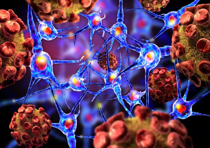 Σκλήρυνση κατά πλάκας: Νέα έρευνα δείχνει ότι τα συμπτώματα μπορεί να ξεκινούν πάνω από 10 χρόνια νωρίτερα