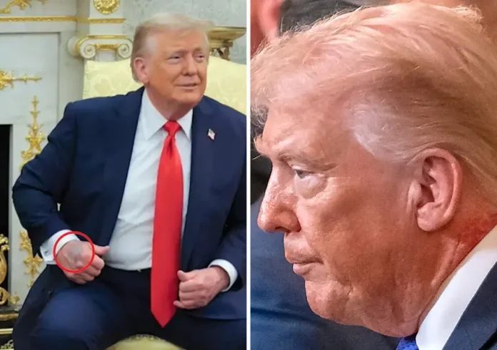 Ντόναλντ Τραμπ: Το «κόκκινο εξάνθημα» στον λαιμό και τα ερωτήματα για την υγεία του