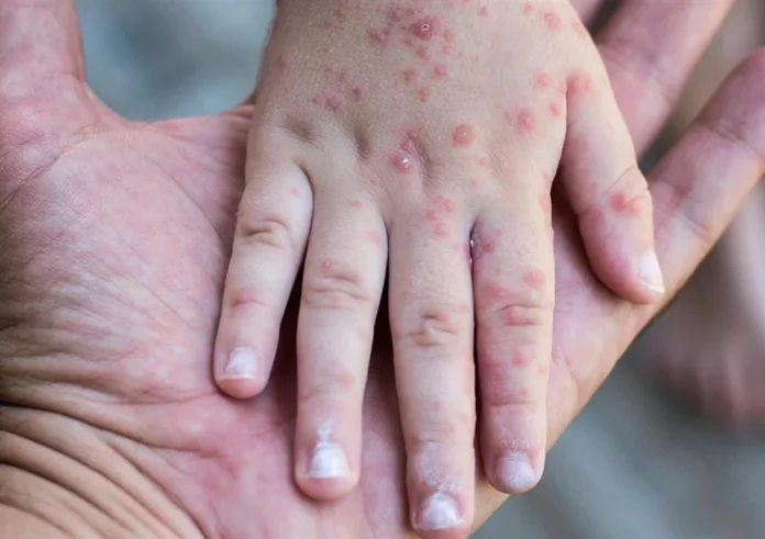 Συναγερμός από τον ΕΟΔΥ: Η ιλαρά συνεχίζει να προκαλεί σοβαρές επιπλοκές και θανάτους