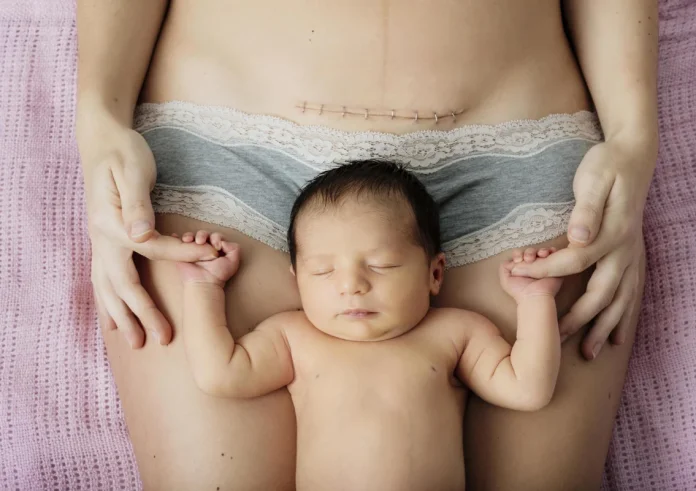 Το συγκλονιστικό σχεδιάγραμμα πουαποδεικνύει γιατί η καισαρική δεν είναι ο «Εύκολος Δρόμος»