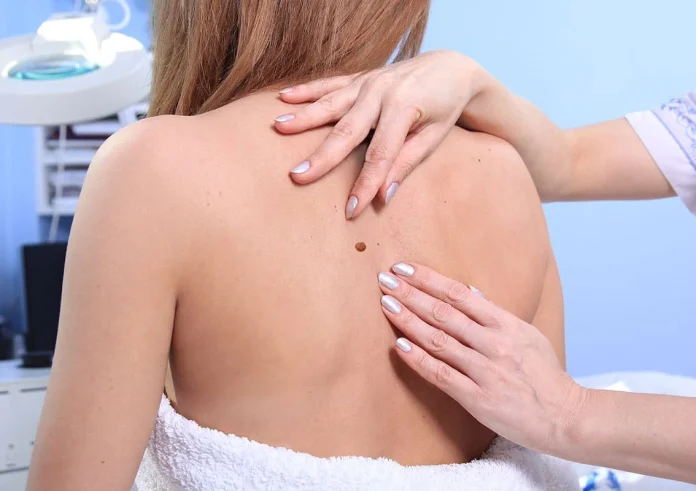 Καρκίνος του δέρματος: Ο «κανόνας ABCDE» για πρώιμη ανίχνευση και προστασία