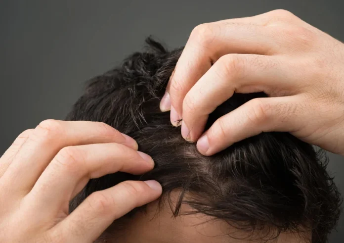 Πιτυρίδα ή ψωρίαση κεφαλιού: Πώς να τις διακρίνετε