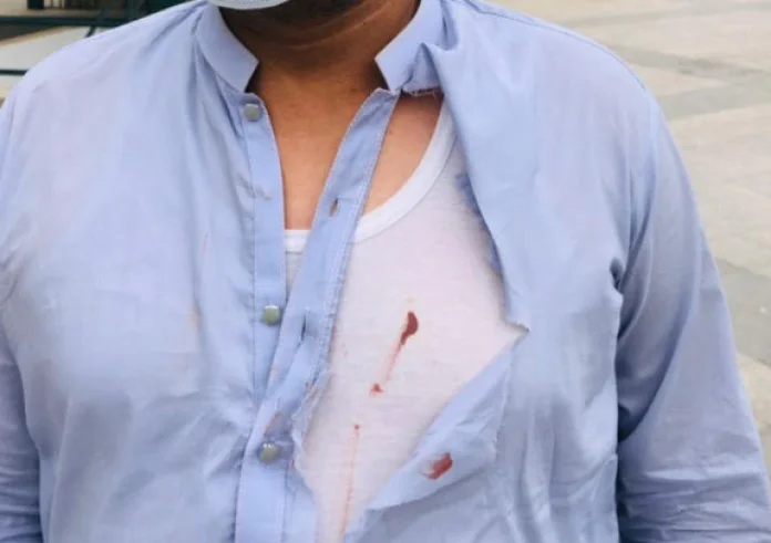 Έκαψαν το σπίτι μου, με έχουν μαχαιρώσει : Άγρια επίθεση σε τρανς γυναίκα στην Πάτρα